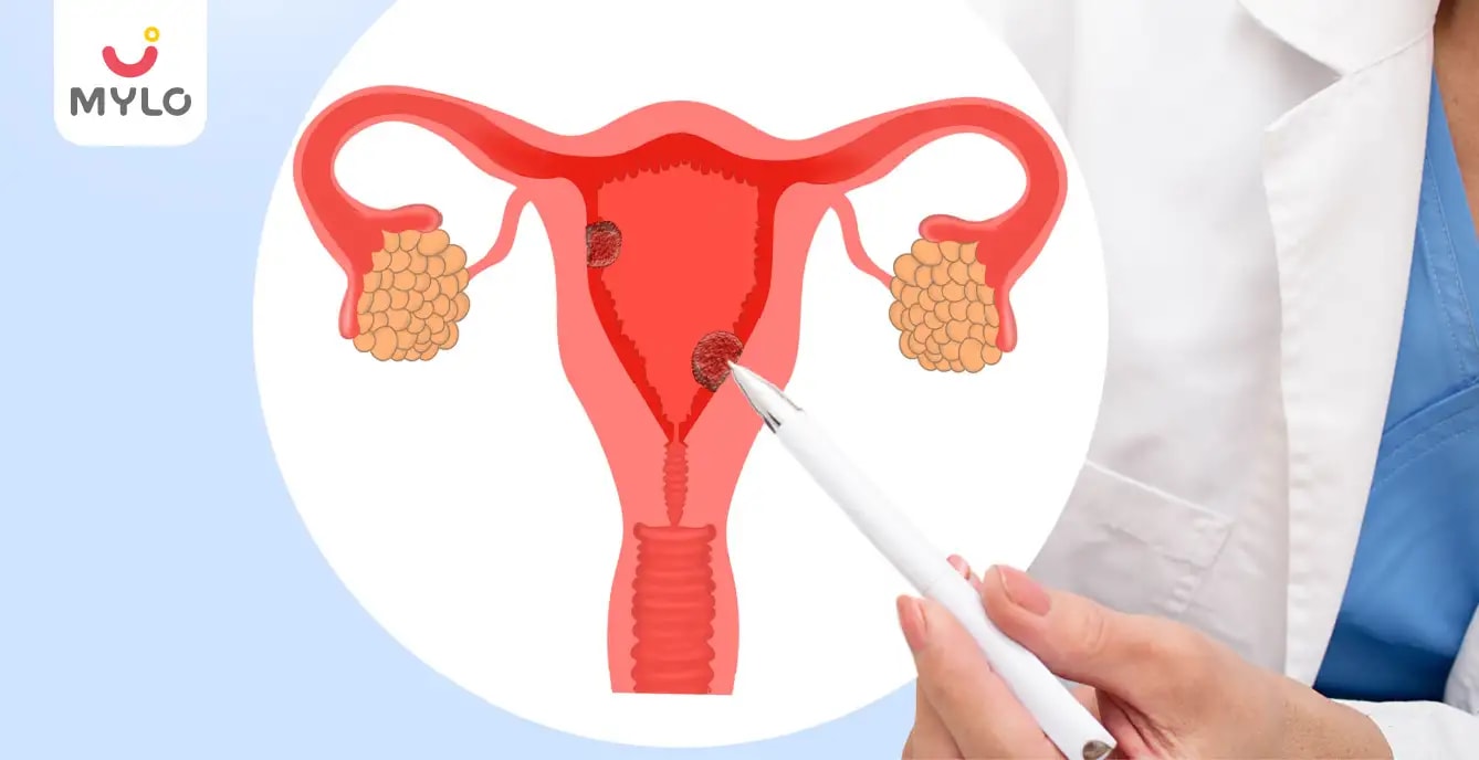 Endometrial Hyperplasia Understanding Its Causes and Treatment