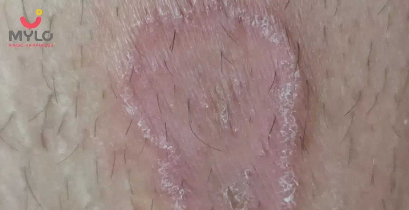 How to cure ringworm in toddlers