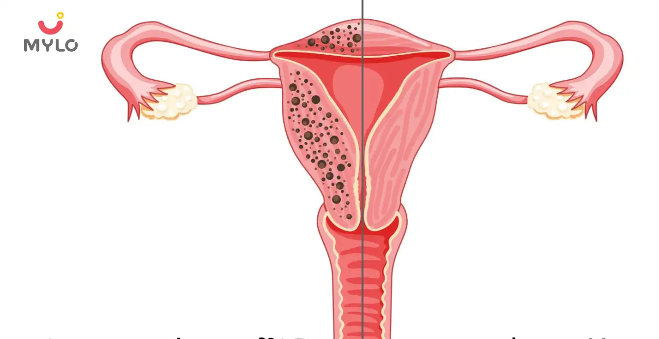 Adenomyosis vs Endometriosis in Hindi | फर्टिलिटी पर कैसे होता है एंडोमेट्रियोसिस और एडिनोमायोसिस का असर?