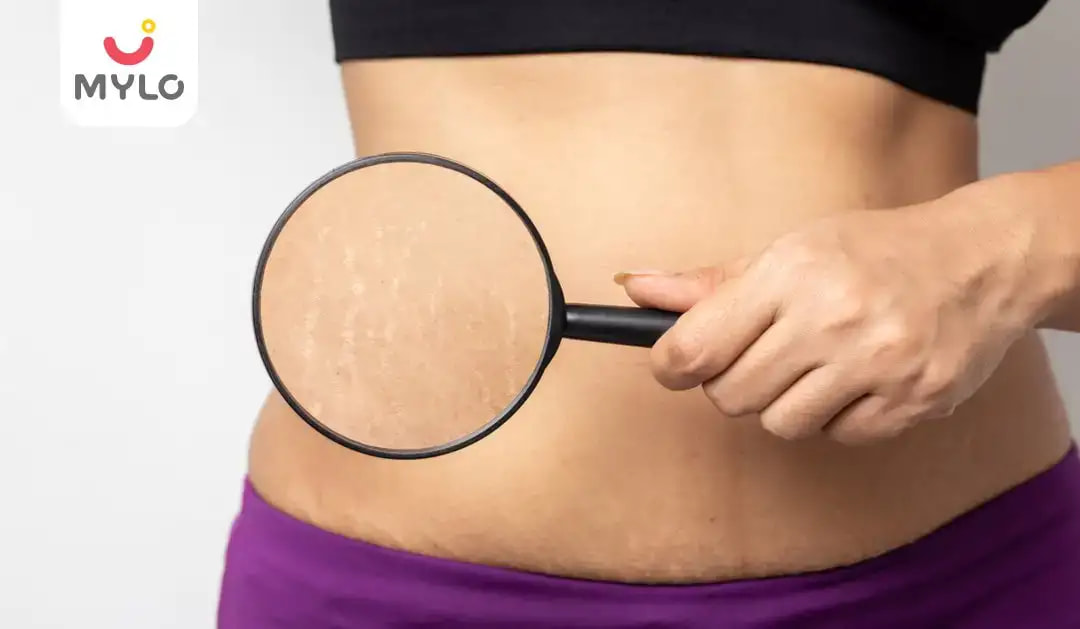 Stretch Marks Removal: Tips & Remedies