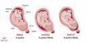 Images related to What is Low-Lying Placenta: Causes, Symptoms, Treatment, Risk Factors and Travel Restrictions