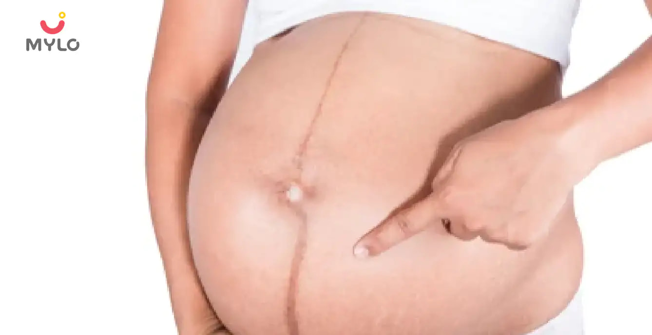 Everything You Need to Know About Linea Nigra, the Line Around Your Belly