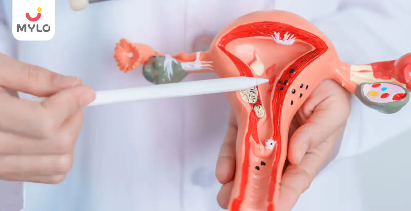 Endometrial Polyps in Hindi| गर्भधारण की मुश्किलें बढ़ा सकता है एंडोमेट्रियल पॉलीप्स!