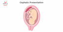 Images related to The ABCs of Cephalic Presentation: A Comprehensive Guide for Moms-to-Be