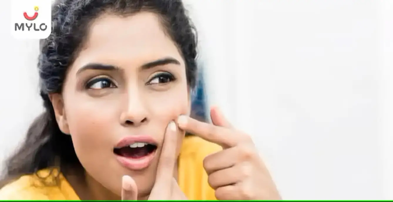 சருமத்தில் உள்ள முகப்பருவை இயற்கையாக நீக்குவதற்கான 5 சிறந்த வழிகள் (Top 5 Natural ways to get rid of acne from your skin In Tamil) 