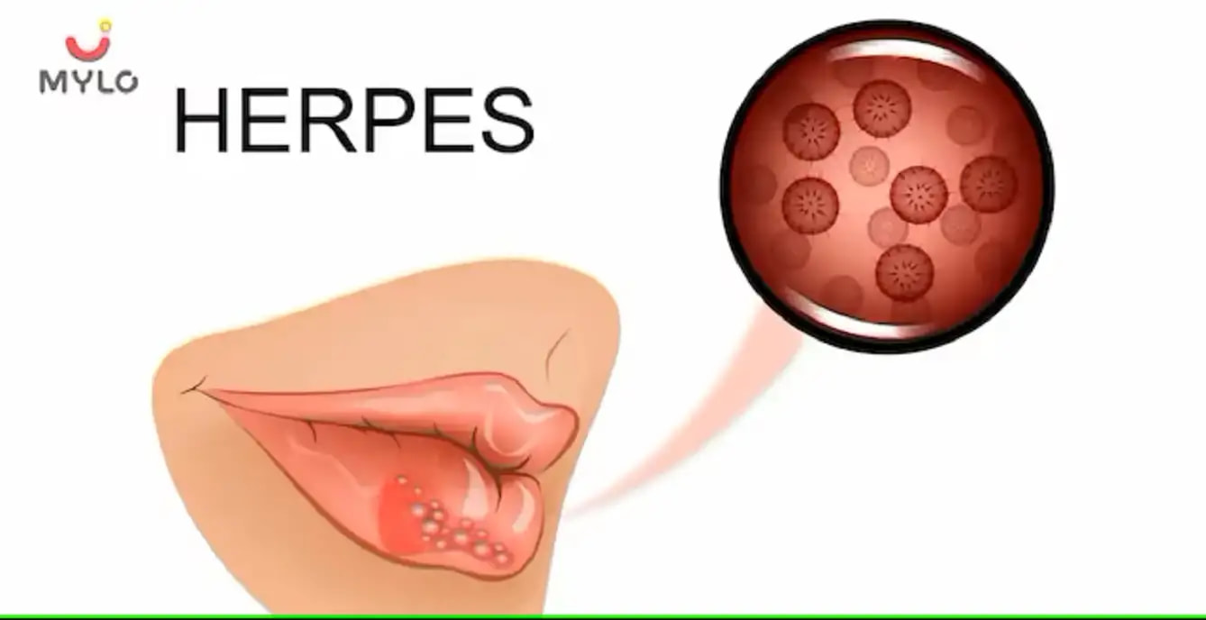 அக்கி (ஹெர்பெஸ்): காரணங்கள், அறிகுறிகள், ஆபத்து மற்றும் சிகிச்சை(Herpes: Causes, Symptoms, Risk & Treatment  In tamil)