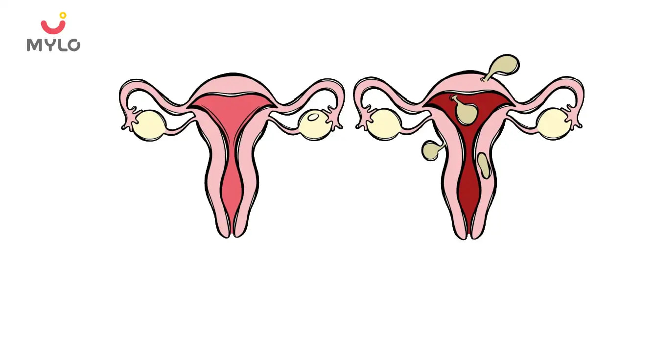 Bulky Uterus with Fibroids: Understanding Causes, Symptoms, and Treatment Options