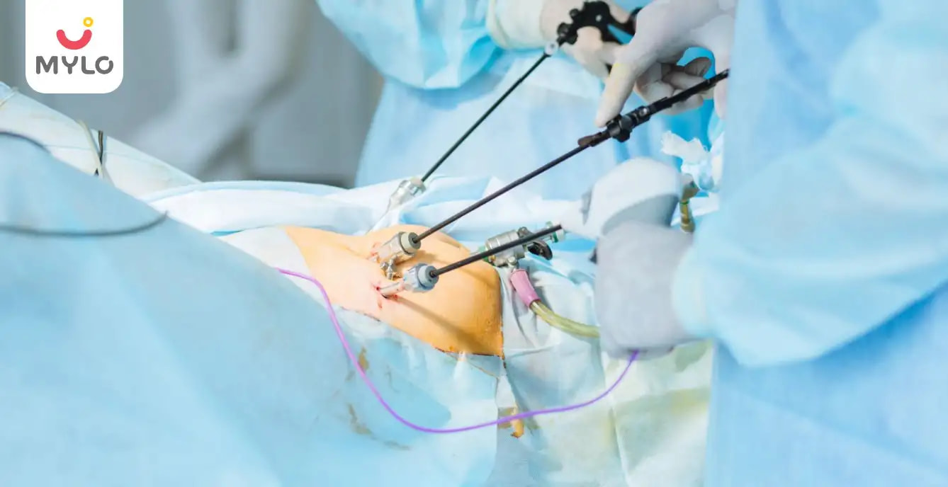 Laparoscopic Ovarian Drilling: A Safe and Effective Solution for PCOS-Related Infertility  