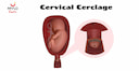 Images related to Things Not to Do After Cervical Cerclage for a Healthy Pregnancy