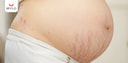 Images related to Reasons Why Stretch Marks Appear During Pregnancy?