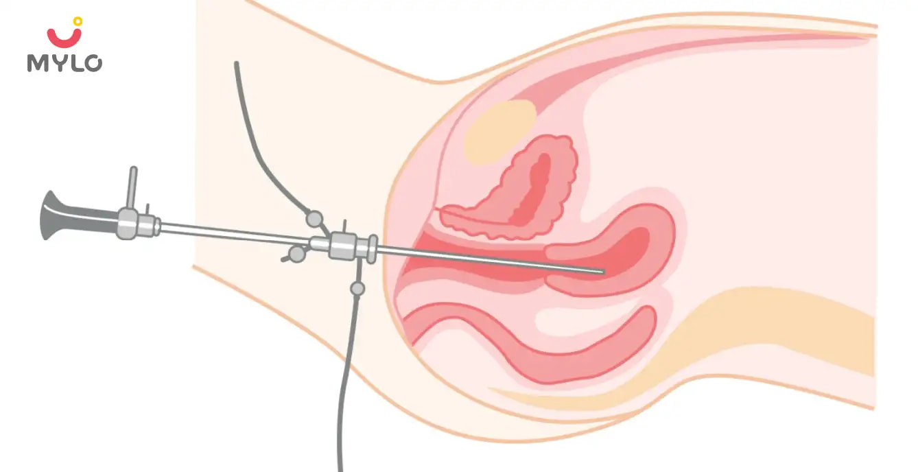 Hysteroscopy in Hindi | हिस्टेरोस्कोपी की ज़रूरत कब पड़ती है? 